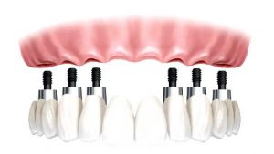 Urgencia dental en Rancagua - Centro de Especialidades Odontológicas