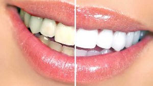 Urgencia dental en Rancagua - Centro de Especialidades Odontológicas